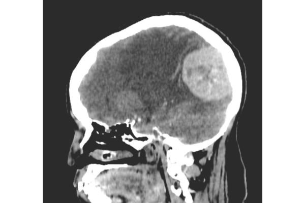 Meningiomas — Medilex: The Experts on Medical Experts